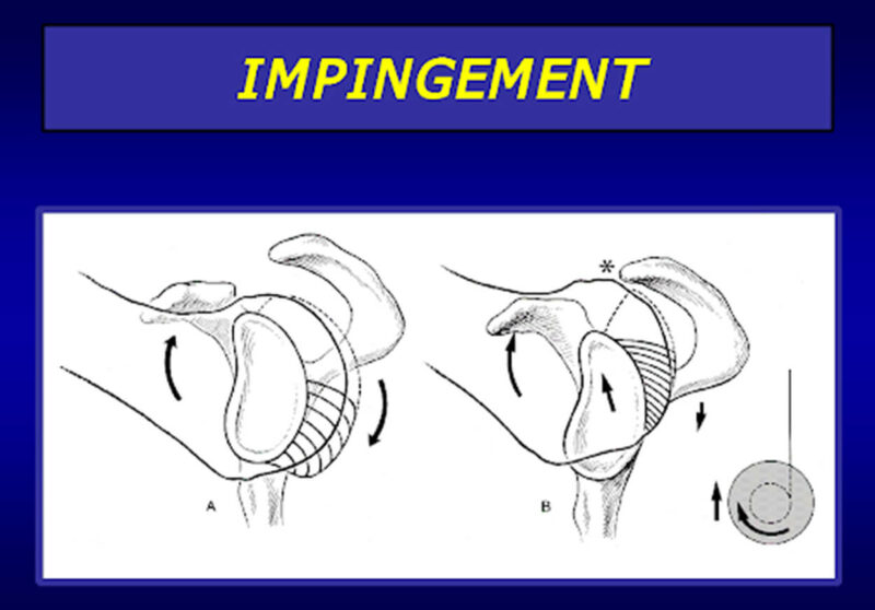 spalla impingement